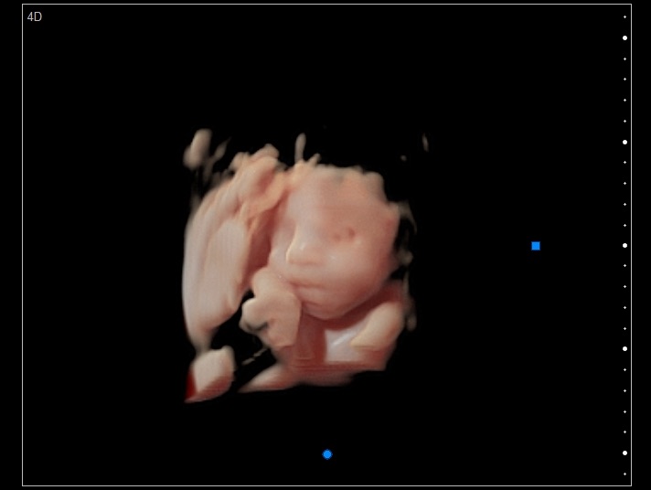 4D ultrasound — stunning baby face and body rendering