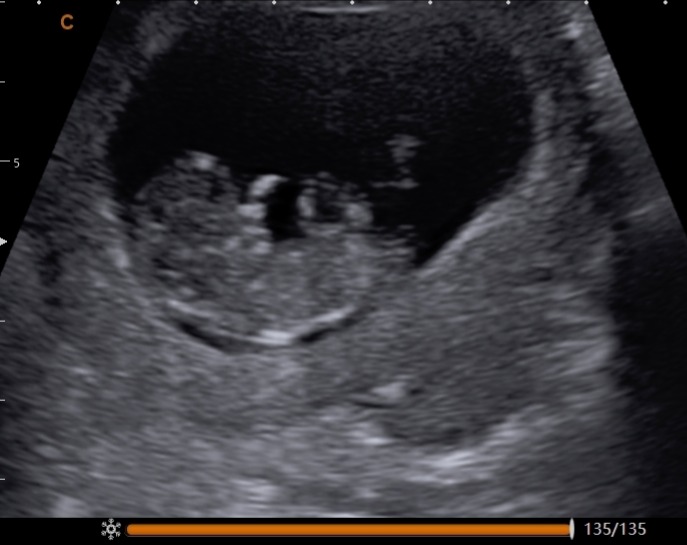 2D ultrasound — early pregnancy scan