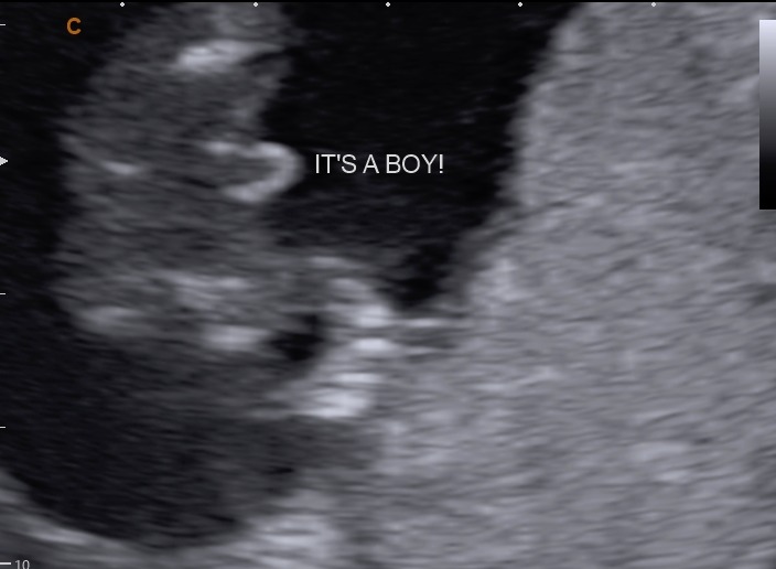 Gender reveal ultrasound — It's a boy!
